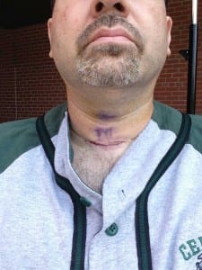 David Esrati's neck after parathyroid surgery